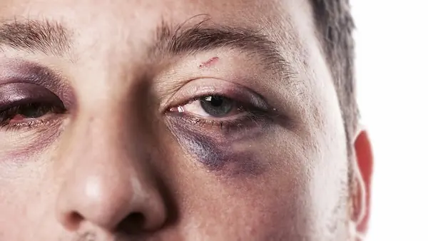 hombre con lesión ocular