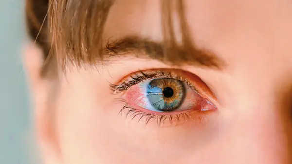 causas más comunes del ardor en los ojos