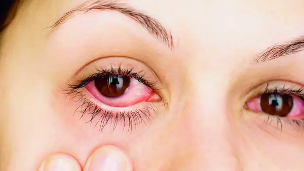 Qué es el ardor en los ojos