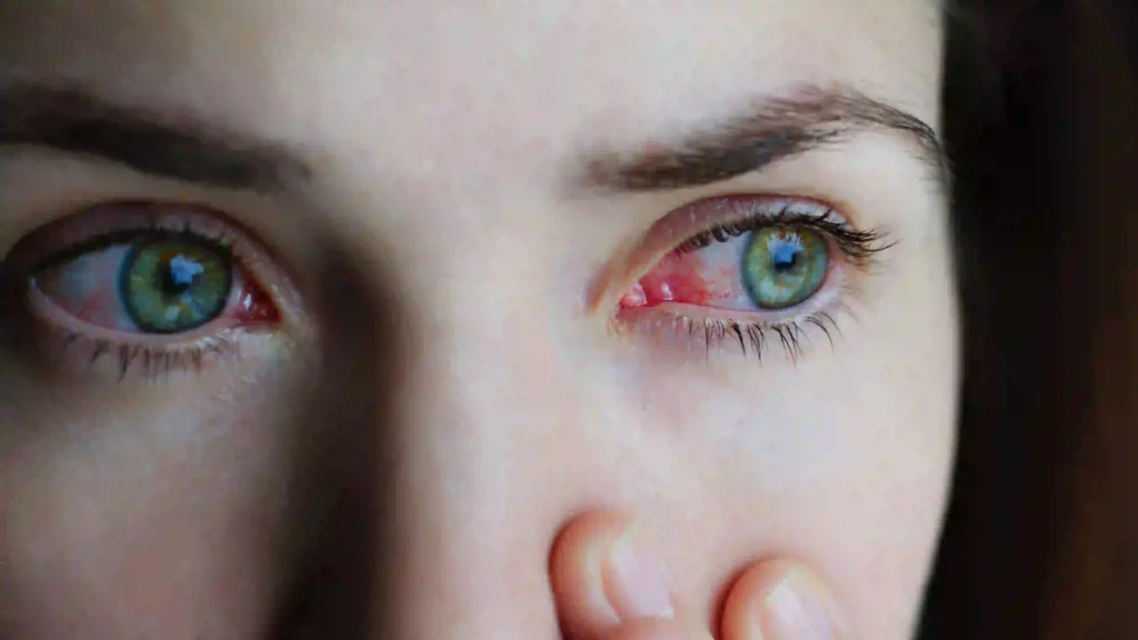 causas del ardor en los ojos