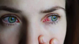 causas del ardor en los ojos