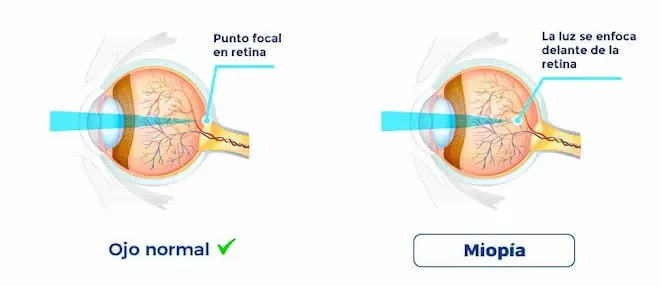 Qué es exactamente la miopía