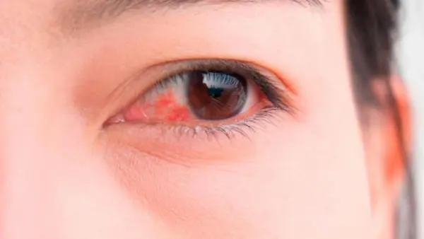 ¿Qué es la alergia en los ojos