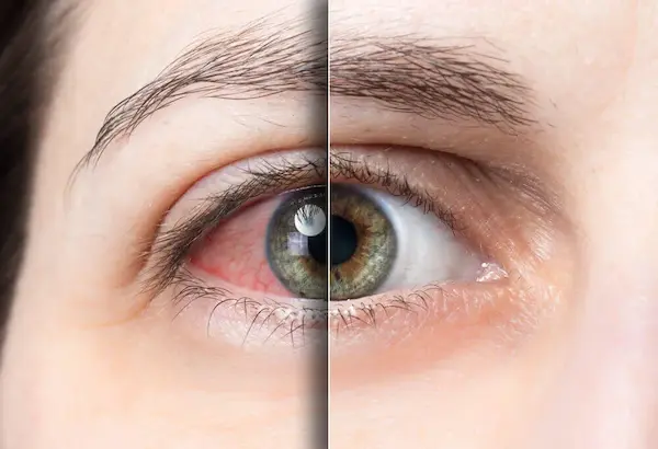 Consejos para detectar problemas en la retina del ojo