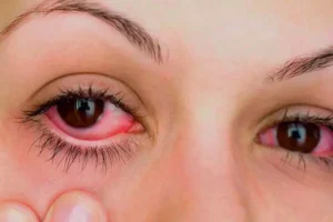 ojos llorosos