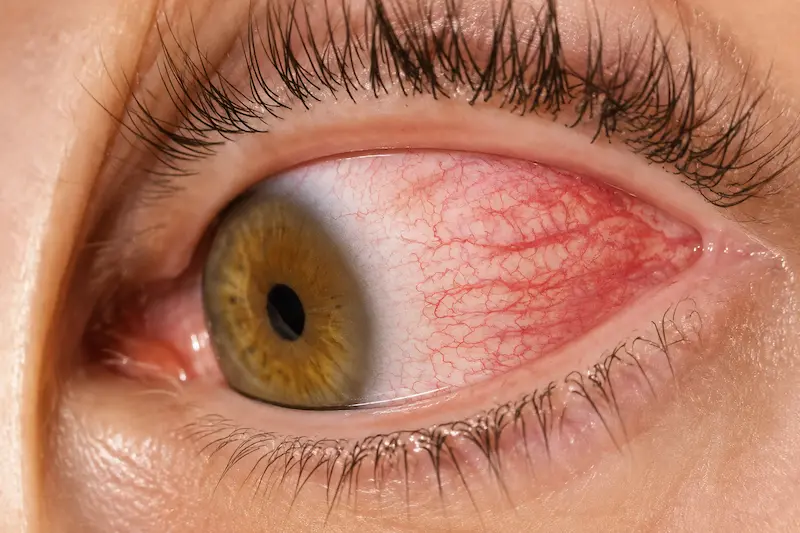 Las 4 causas más comunes del ardor en los ojos