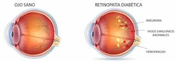 Qué es la retinopatía diabética y cómo afecta al ojo
