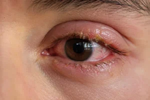 secreciones en los ojos