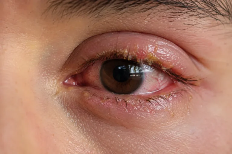 secreciones en los ojos