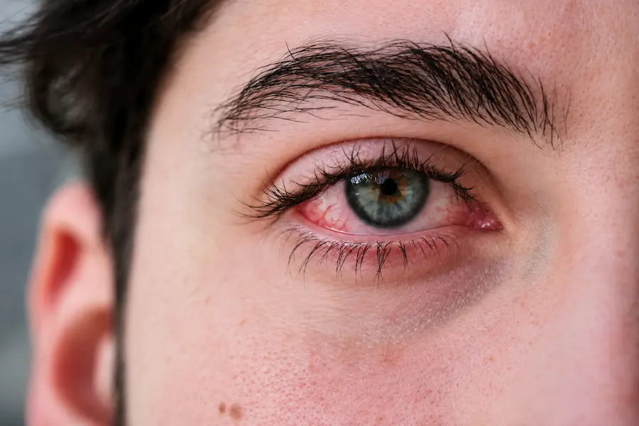 Preguntas frecuentes sobre la conjuntivitis
