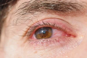 tipos de conjuntivitis