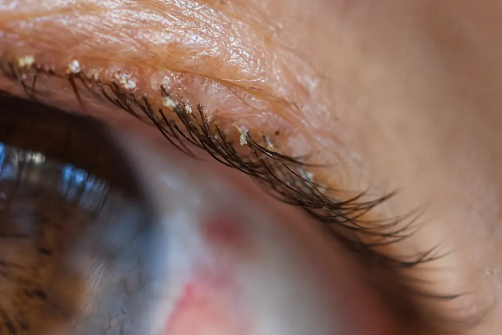 ¿Cómo prevenir problemas relacionados con Demodex