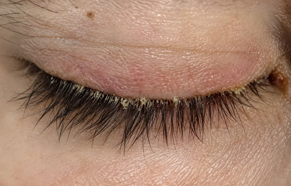 ¿Cuáles son los síntomas de Demodex
