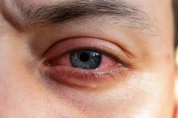 ¿Por qué se genera la conjuntivitis