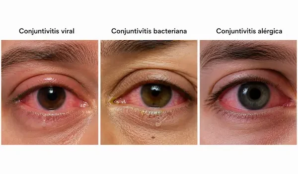 ¿Qué tipos de conjuntivitis existen